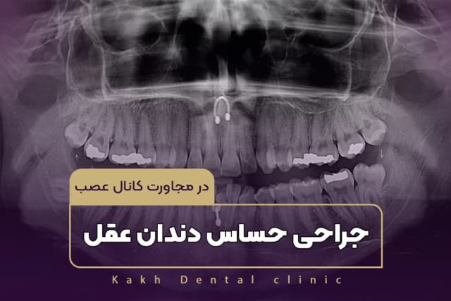 جراحی حساس دندان عقل در مجاورت کانال عصب
