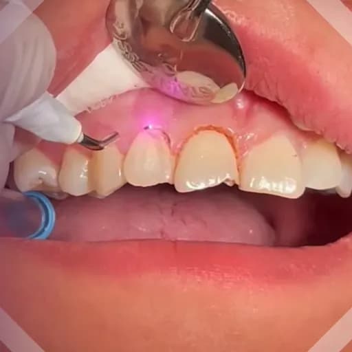 لیزر بافت نرم